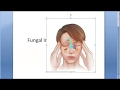 ENT Fungal Sinusitis Fungus infection sinus Ball Allergic Chronic Fulminant