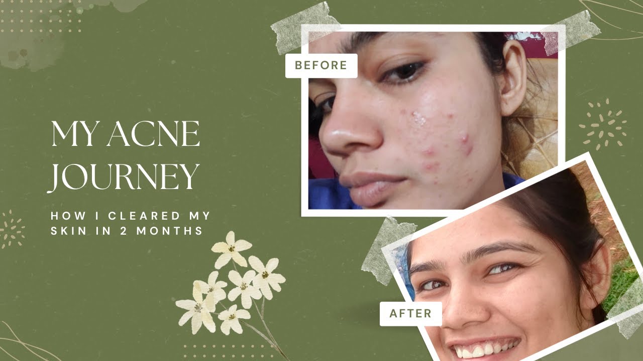 My Acne Journey| Clear Skin in 2 Months | Holistic Skincare Tips & Home ...