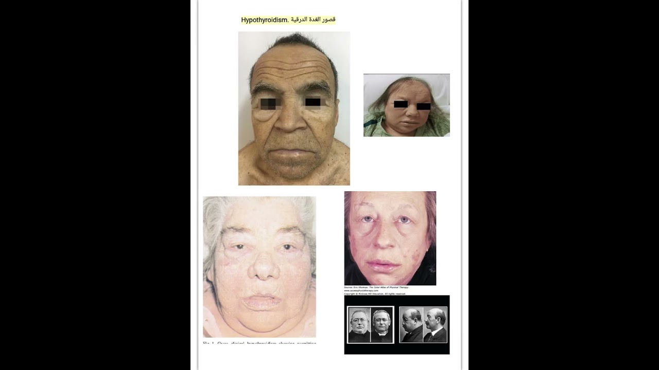 Medicine || Thyroid Gland || anatomy physiology hyperthyroidism hypothyroidism goiter cancer 