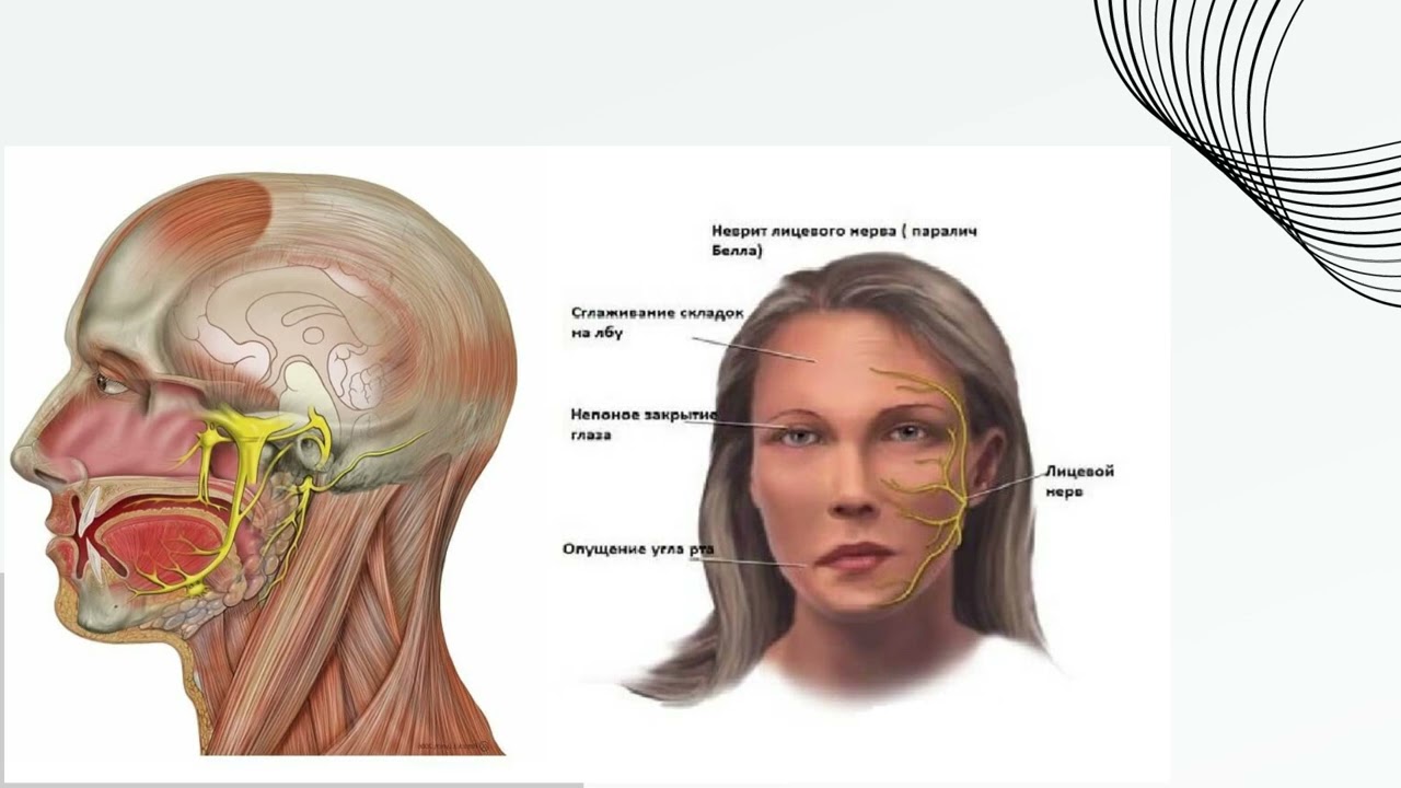 Неврит лицевого нерва отзывы