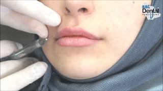 حقن الشفاه بالفيلر  - د.عامر قنباز ... Dr.Amer Kunbaz - Lip Augmentation - Filler injection