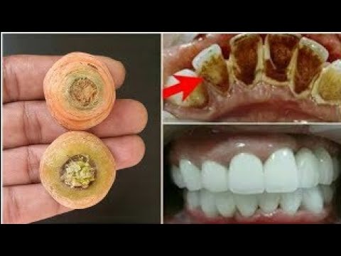 Video: 8 Bedste Naturlige Tandpastaer Til Plak, Tandkødsbetændelse & Hulrum