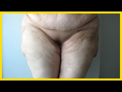 Vaser Liposuction New Technique Of 2017