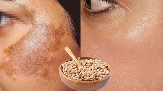 in 3 days| Remove Skin pigmentation, Melasma, and Dark spots freckles From Face Naturally