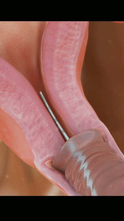 Insertion of IUD (Intrauterine Device) to Prevent Pregnancy | Birth Control #4k #animation #asmr