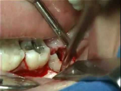 extraction wisdom tooth impacted (www.oralcamera.net)