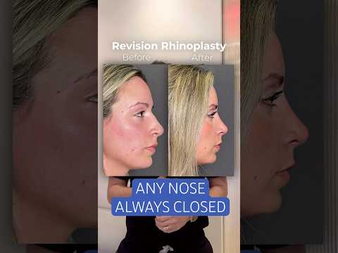 Video thumbnail: ANY Nose— ALWAYS Closed #plasticsurgery · Albert Plastic Surgery New York
