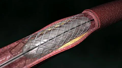 ¿Puede un stent desobstruir una arteria?