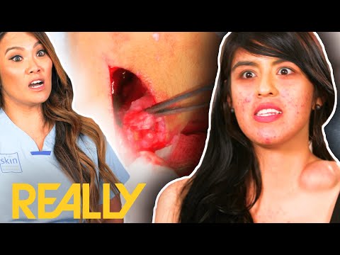 Dancer Gets Neck Lump Removed To Improve Her Career | Dr. Pimple Popper: This Is Zit