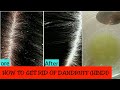 Magical Home Remedy to Remove DANDRUFF at home//Dandruff treatment/How to get rid of dandruff