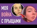 Победа Над Прыщами || Что Помогло?