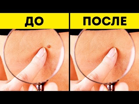 Вопрос: Как избавиться от кожного нароста на шее?