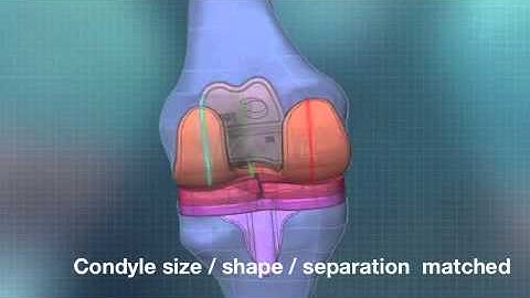Custom Total Knee Replacement & 3D Printing ConforMIS iTotal.