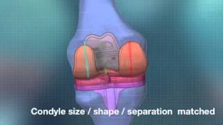 Custom Total Knee Replacement & 3D Printing ConforMIS iTotal.