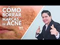 COMO BORRAR MARCAS DE ACNE