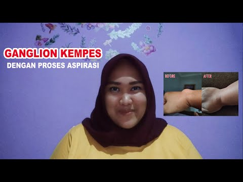 CARA MENGHILANGKAN GANGLION DENGAN PROSES ASPIRASI