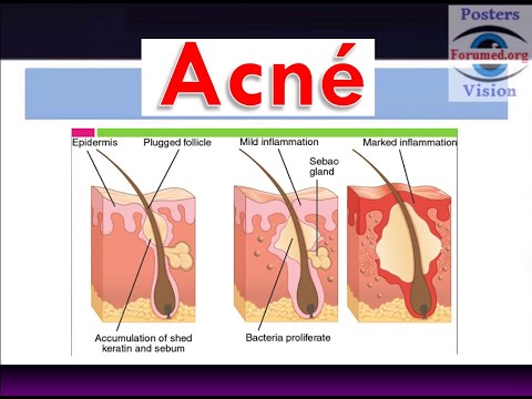 Vidéo: D'où vient l'acné vulgaire ?