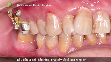 Mất răng bị xô hàm, niềng răng chỉnh sửa trước, sau mới cấy răng implant (điều trị mất 1 năm)