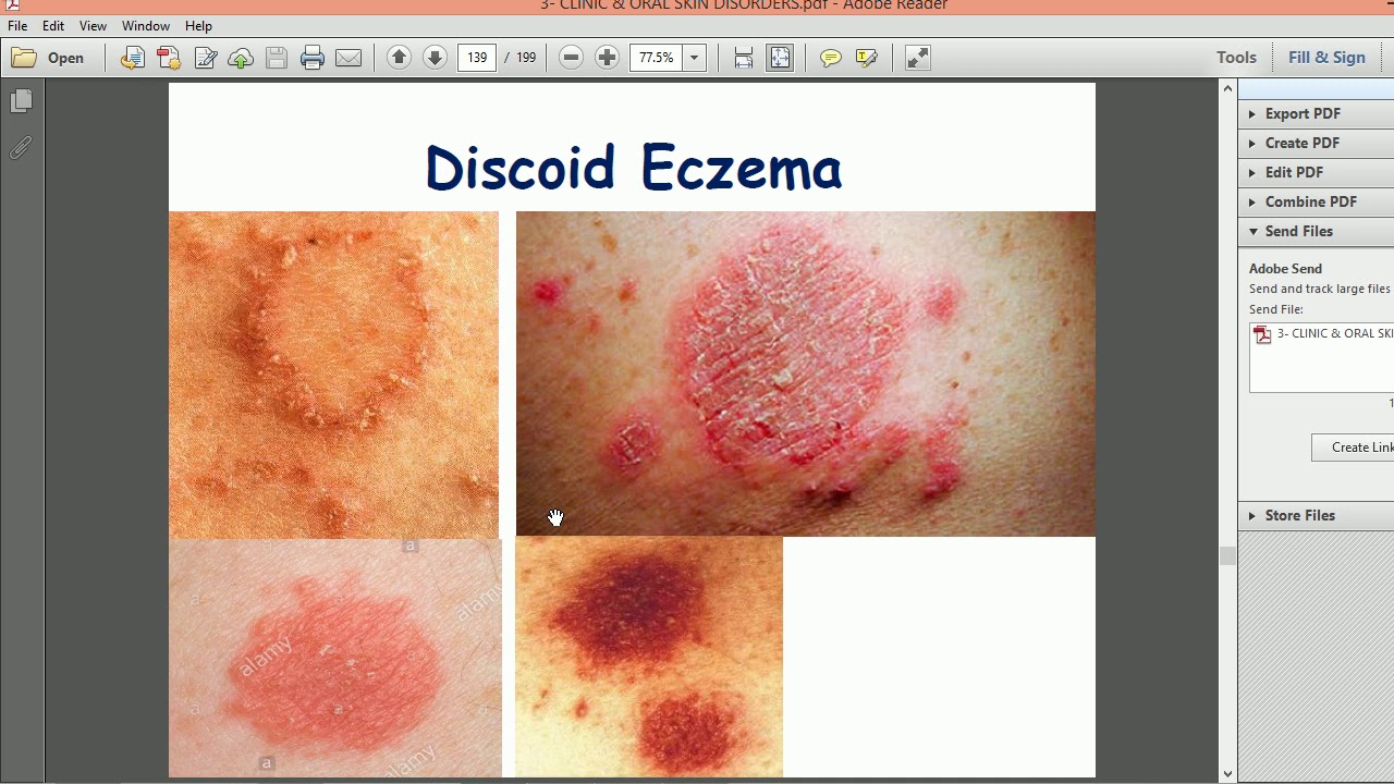 eczema 3 