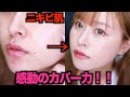 【ニキビ跡】感動のカバー力の優秀ファンデ見つけた!!