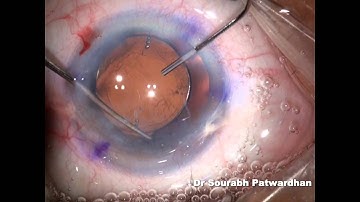 Smart toric IOL: customised toric IOL for correcting 10D astigmatism by Dr Sourabh D Patwardhan