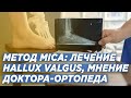 ЛЕЧЕНИЕ КОСТОЧКИ НА НОГЕ С ПОМОЩЬЮ МЕТОДА MICA: ПЛЮСЫ И МИНУСЫ. ДОКТОР ОРТОПЕД ИГОРЬ ПАХОМОВ.