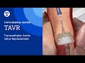 TAVR (Transcatheter Aortic Valve Replacement) | Tufts Medical Center