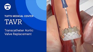 TAVR (Transcatheter Aortic Valve Replacement) | Tufts Medical Center