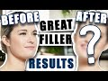 Incredible Lip Filler Transformation: Before &amp; After