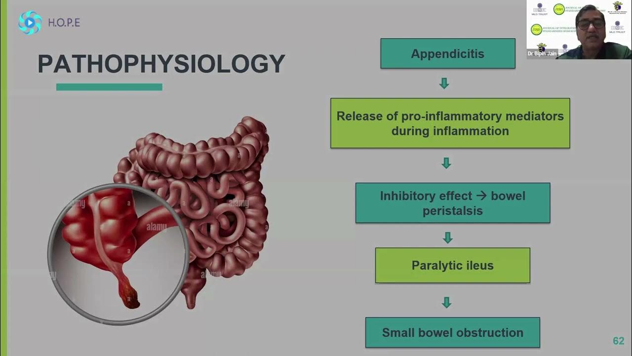 a-case-of-subacute-appendicitis-with-intestinal-obstruction-by-dr-bipin