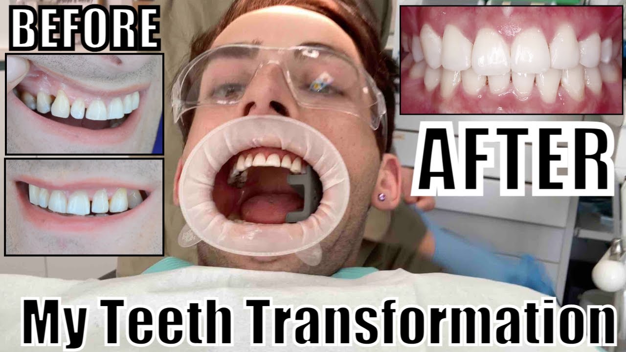 GETTING COMPOSITE VENEERS!(Cost? & What is Dental Bonding?) YouTube