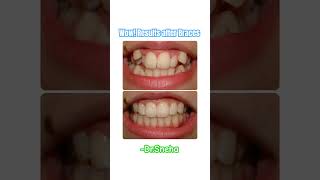 😱😍Beautiful results after braces #bracesoff #hyderabaddentist #dentist #orthodontist #trend