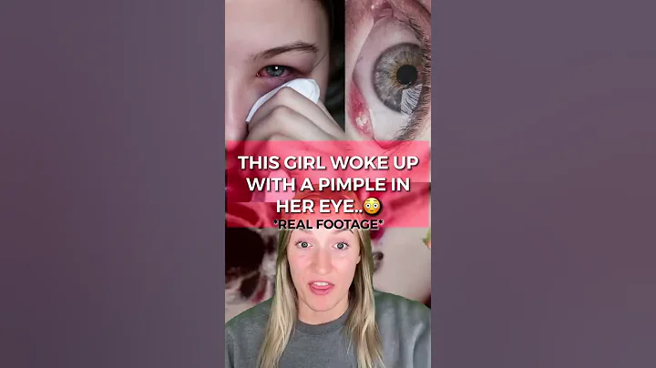 THIS GIRL WOKE UP WITH A PIMPLE IN HER EYE!😳 - DayDayNews