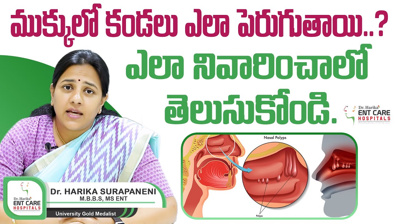 How to Treat Nasal Polyps Diagnosis and Treatment of Nasal Polyps