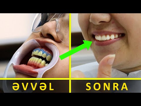 Video: Peşəkar dişlərin ağardılması nə qədərdir?