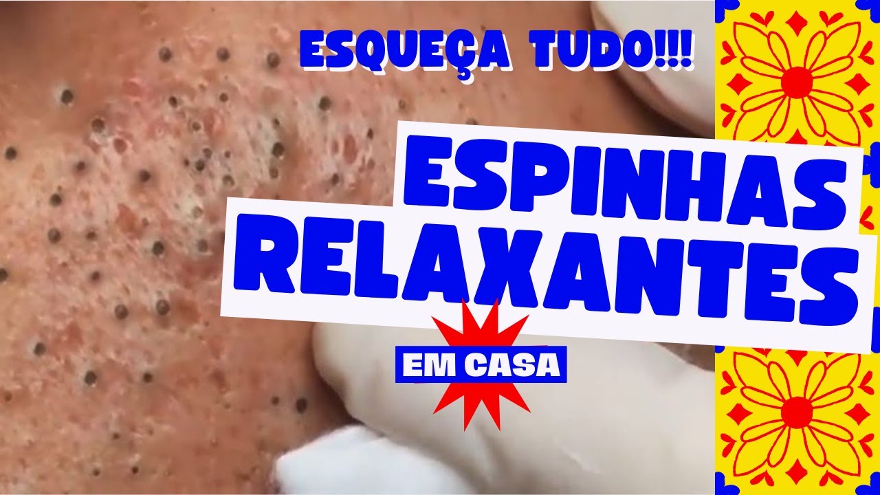 CRAVOS E ESPINHAS LIMPESA DE PELE ESPINHAS GIGANTES 2022 - YouTube