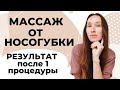 Удаление носогубных складок | Результат после 1-й процедуры!