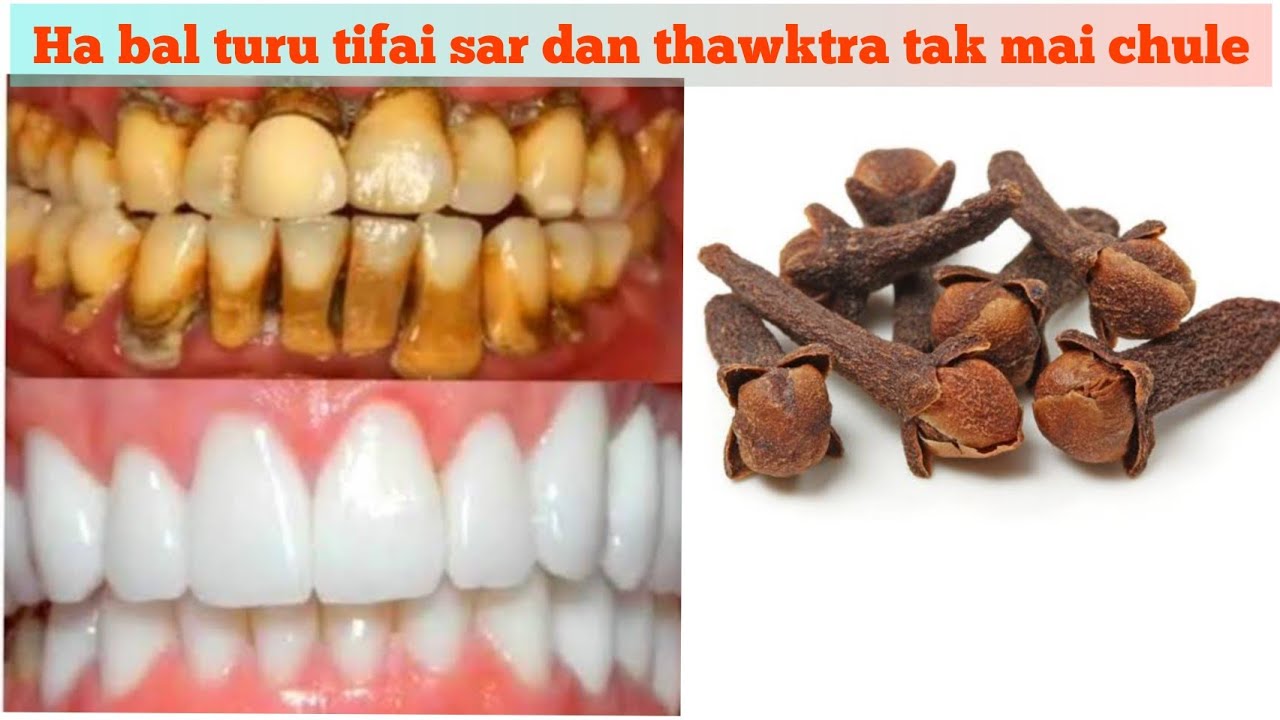 Ha bal turu tihfai sar dan thawk tra tak mai chu le.. how to get rid of yellow teeth