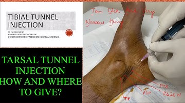 TARSAL TUNNEL INJECTION. WHERE AND HOW TO GIVE IT. DR HAKAM SINGH