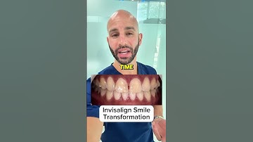 Can Invisalign close my gap? How long will it take?