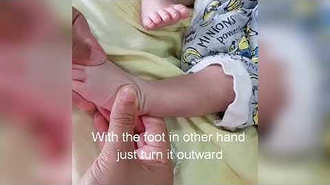 Maternal manipulation for clubfoot/CTEV