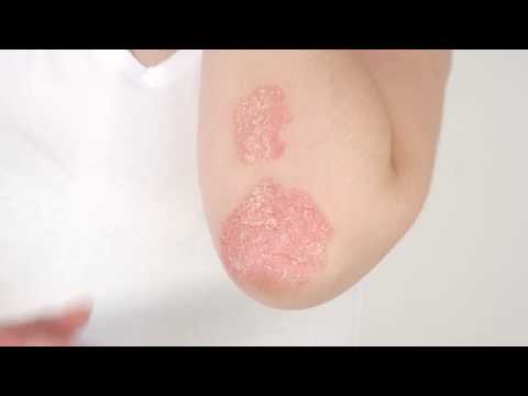 Video: Psoriasisartrittest: Hvordan Diagnostiseres PsA?