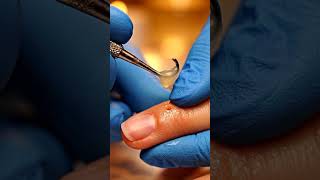 😲 Watch the Blackhead Extraction Perfection