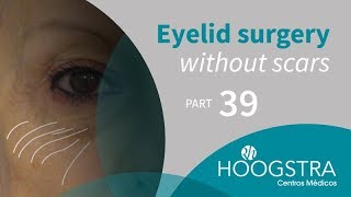 Eyelid surgery without scars - Part 39