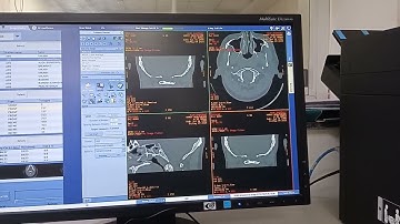 HOW TO DO HRCT TEMPORAL BONE FILMING