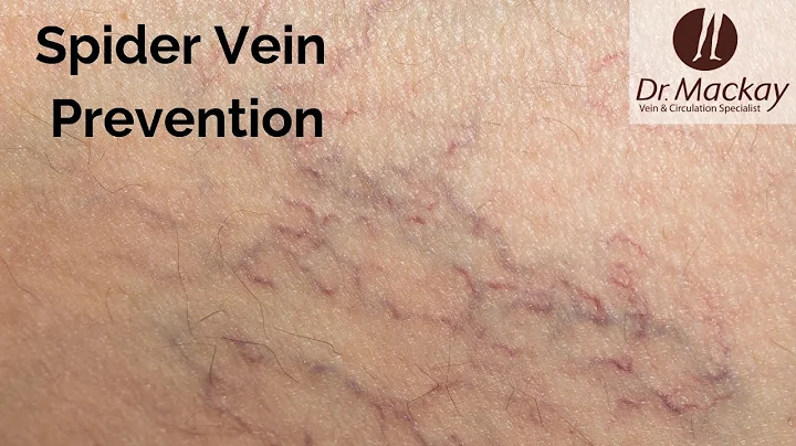 Spider Veins Prevention & Tips to Reduce Risk by Dr. Mackay Vein Specialists