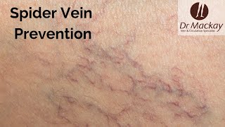 Spider Veins Prevention & Tips to Reduce Risk by Dr. Mackay Vein Specialists