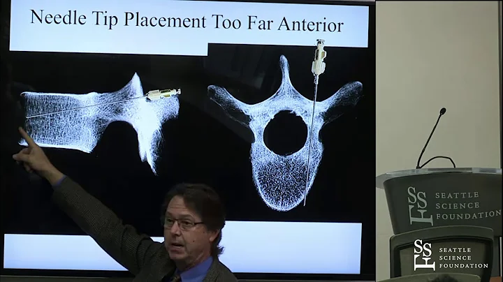 Approaches for Vertebral Augmentation: Transpedicular Approach - Neal Shonnard, M.D.