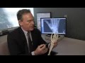 Treating Basal Thumb Joint Arthritis - Mayo Clinic