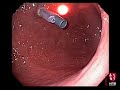 Laparoscopic Endogastric Resection of Endoluminal Tumors: Technique and Variations